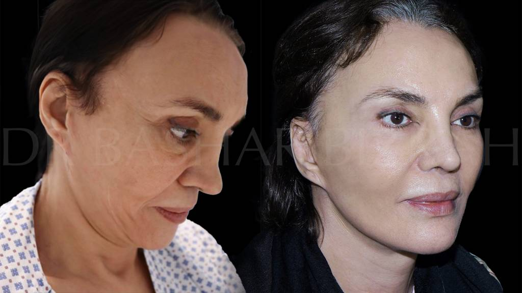 Can a Facelift in Dubai Deliver the Natural, Youthful Results You’ve Been Hoping For?